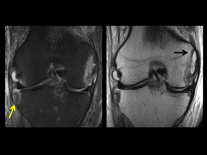 Figure 2 for case avulsion fracture ( RID4653 )